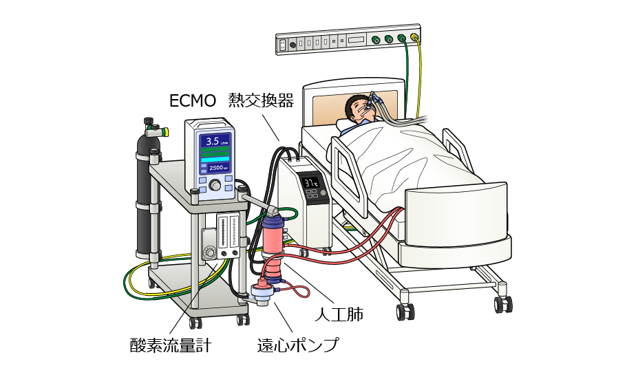 医療機器の種類 Ecmo Extracoporeal Membrane Oxygenation 体外式膜型人工肺 医機なび 就活生のための医療機器業界情報発信webマガジン