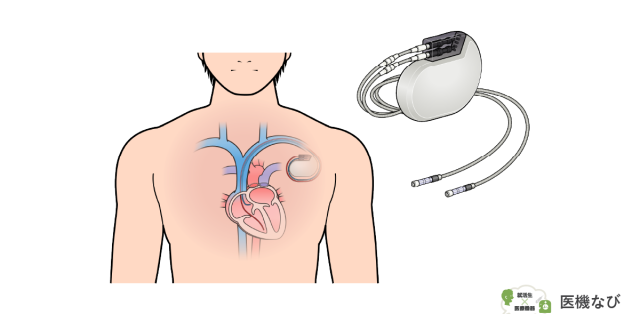 【医療機器の種類】<br>ペースメーカ