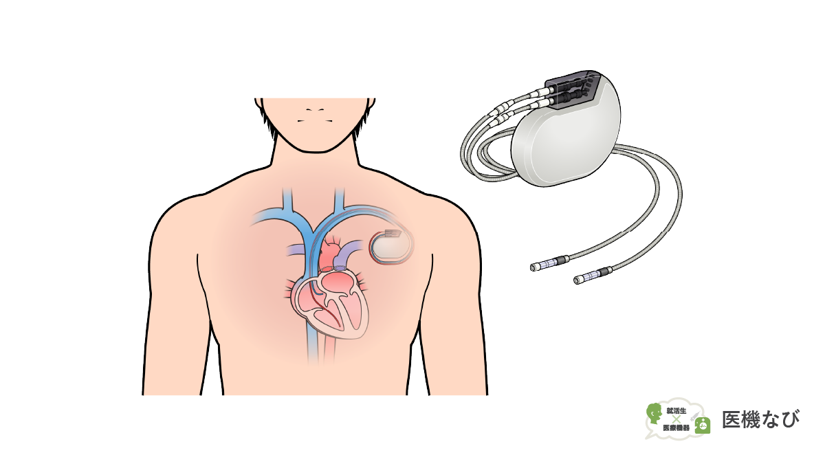 【医療機器の種類】<br>ペースメーカ