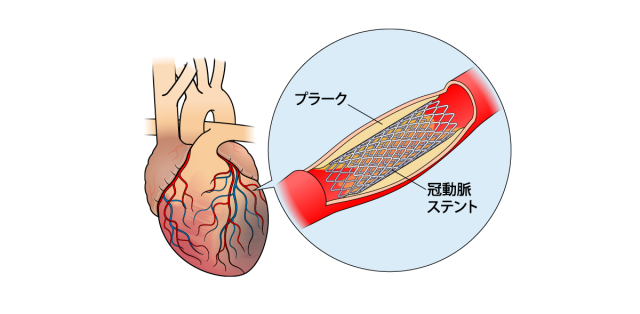 【医療機器の種類】<br>ステント
