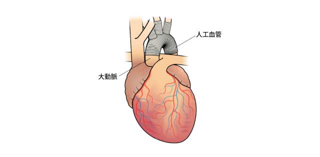 【医療機器の種類】<br>人工血管