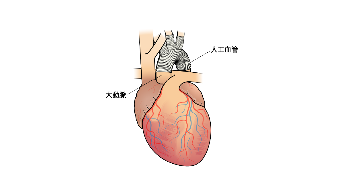 【医療機器の種類】<br>人工血管