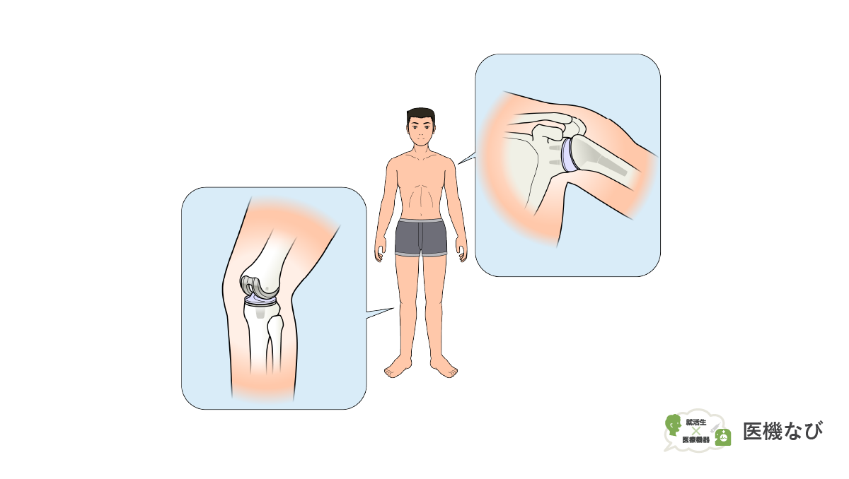 【医療機器の種類】<br>人工関節