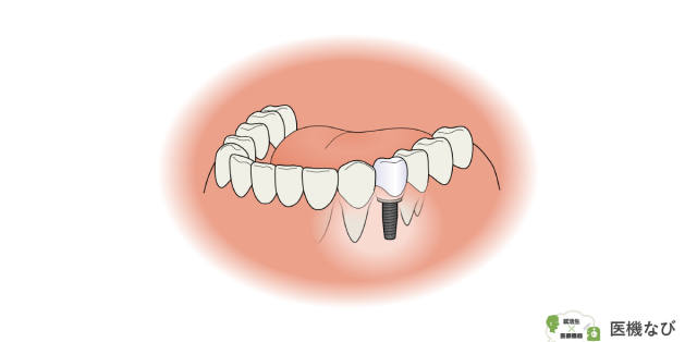 【医療機器の種類】<br>歯科用インプラント