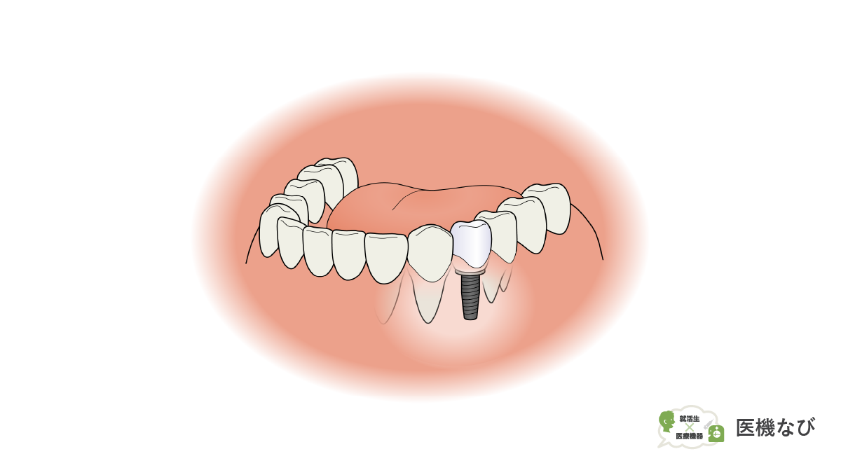 【医療機器の種類】<br>歯科用インプラント