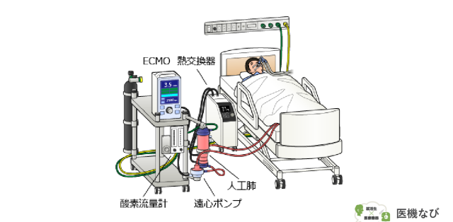 【医療機器の種類】<br>ECMO（Extracoporeal Membrane Oxygenation：体外式膜型人工肺）