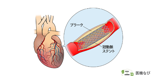 【医療機器の種類】<br>ステント