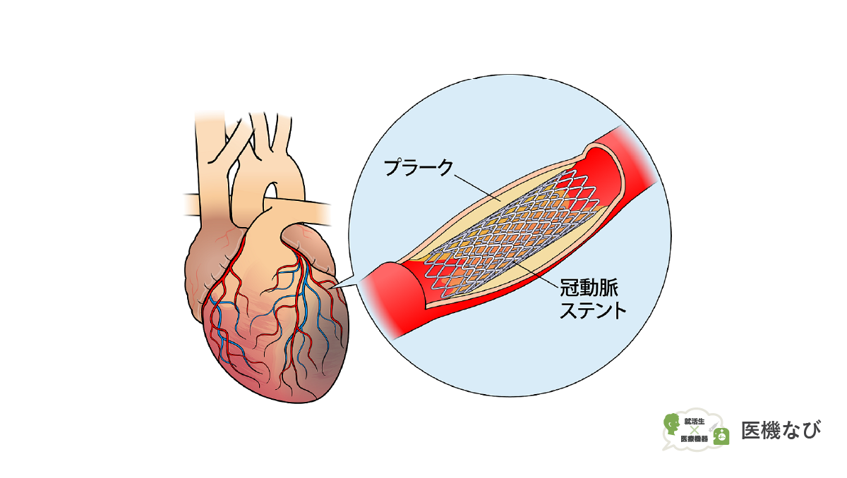 【医療機器の種類】<br>ステント