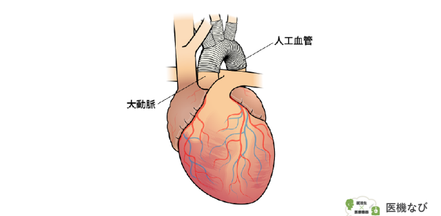 【医療機器の種類】<br>人工血管