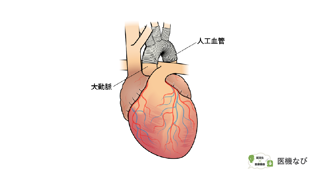 【医療機器の種類】<br>人工血管